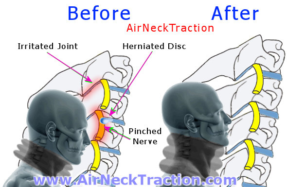 how air neck traction helps