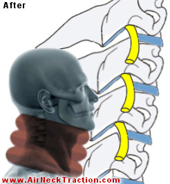 After Air Neck Traction