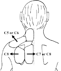 Location of early onset of radiculopathy
