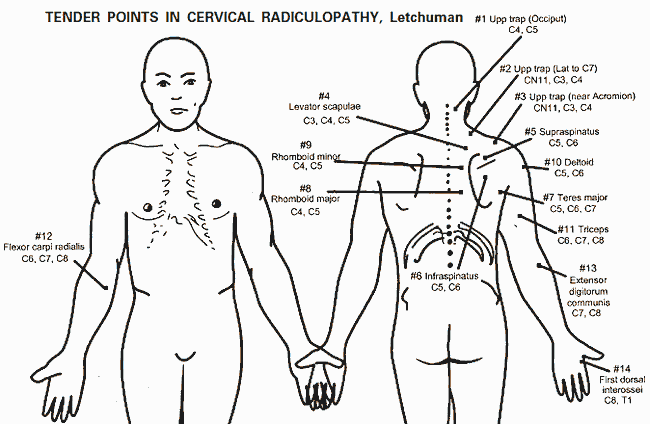 Tender Points In Radiculopathy